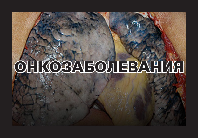 Russia 2013 Health Effects lung - lung cancer, diseased organ